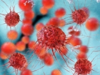 Výskyt zhubných nádorov na Slovensku stúpa