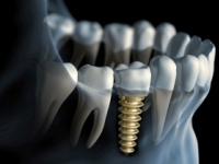 Chýbajú vám zuby? Implantáty sú optimálnym riešením.