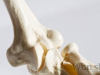Osteoporózou trpia viac ženy, toto sú rizikové faktory