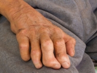 Každé dve minúty diagnostikujú vo svete jeden prípad lepry